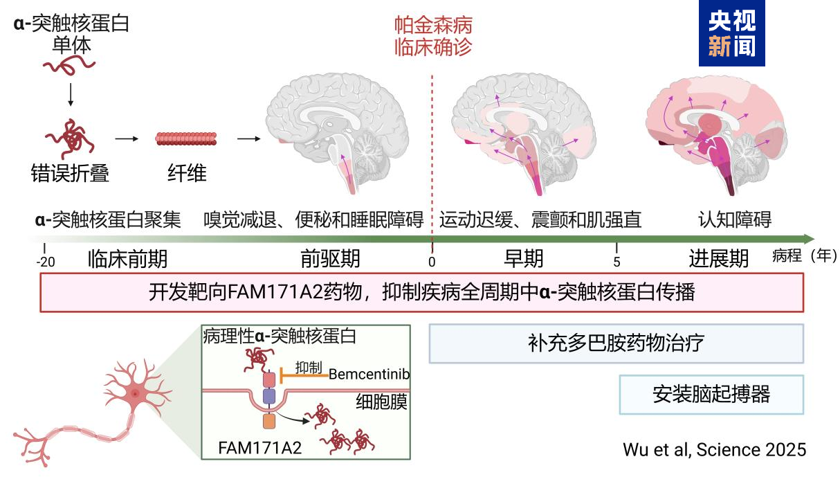 全球首次！复旦科研团队发现帕金森病全新治疗靶点